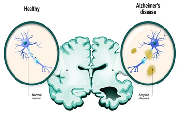 Best Neurologist in India