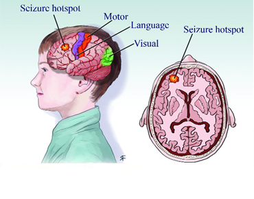 Best Neurologist in India
